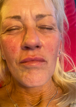 Load image into Gallery viewer, Lip filler before and after

