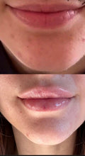 Load image into Gallery viewer, Lip filler ( natural looking lips)
