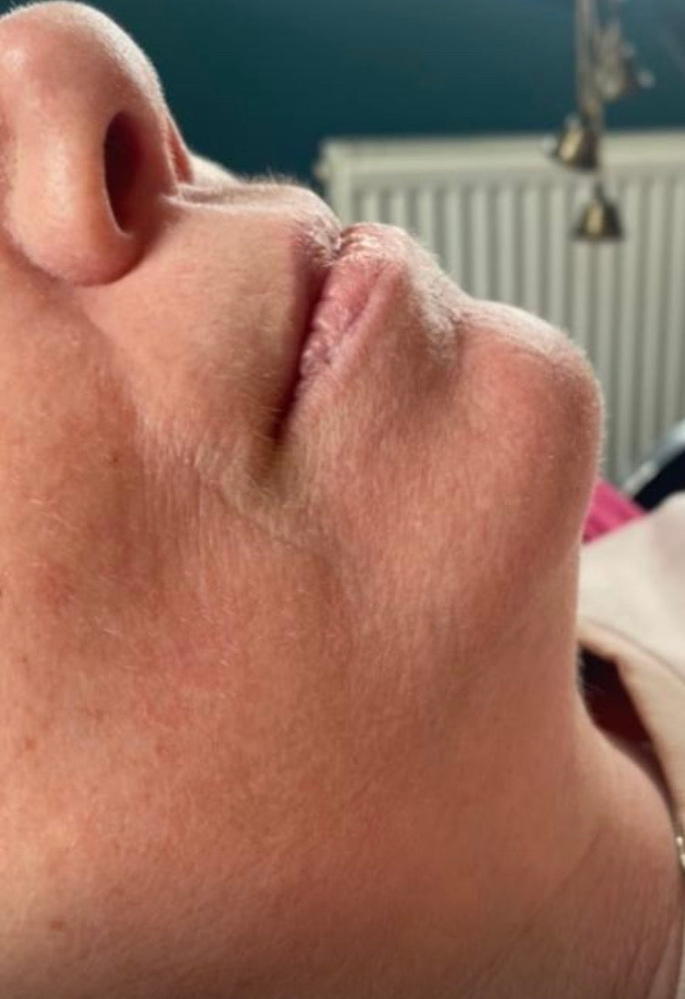 Lips before and after
