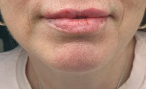 Lips before and after