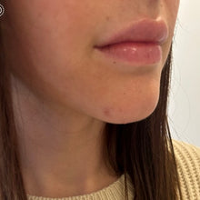 Load image into Gallery viewer, Lip filler ( natural looking lips)
