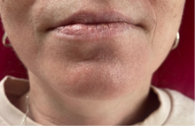 Load image into Gallery viewer, Lip filler before and after pics
