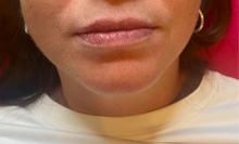 Load image into Gallery viewer, Lip filler before and after pics
