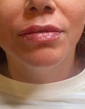 Load image into Gallery viewer, Lip filler before and after pics
