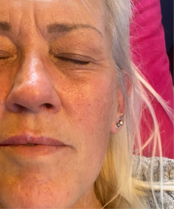 Lip filler before and after